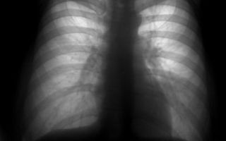 Флюорография и рентген легких: в чем разница, отличие, что лучше?