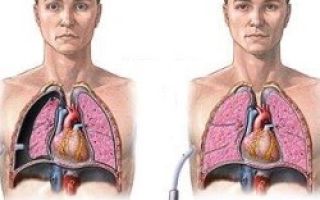 Подкожная эмфизема грудной клетки: причины, лечение и возможные осложнения