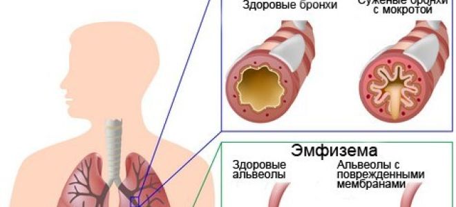 Дыхательная гимнастика при хобл: принципы и техника выполнения