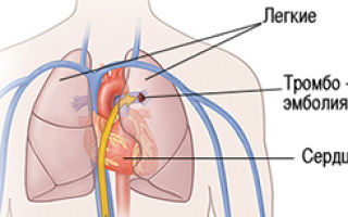 Тэла (тромбоэмболия легочной артерии) – лечение болезни