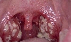 Стрептоцид порошок — применение для горла, отзывы