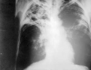 Туберкулез легких: симптомы, виды, диагностика у взрослых