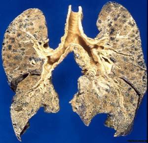 Лечение рака лёгкого и ХОБЛ с помощью нанотехнологий