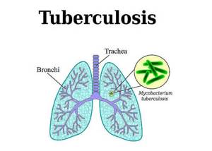 Первые признаки туберкулеза легких на ранних стадиях