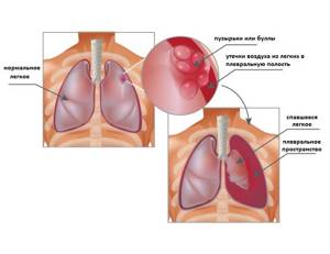 Тяжесть в грудной клетке: посередине, трудно, тяжело дышать, что делать?