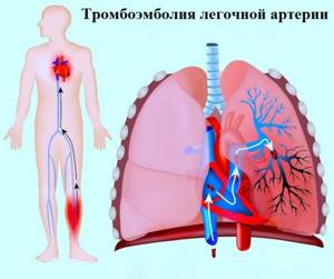 ТЭЛА (тромбоэмболия легочной артерии) – симптомы и неотложная первая помощь