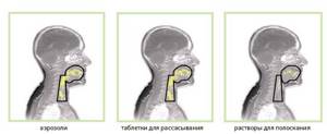 Средства от боли в горле: эффективные, недорогие, лучшие, взрослым, детям, при беременности