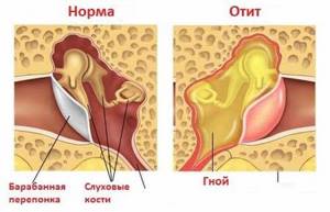 Отит среднего уха – симптомы и лечение у взрослых