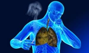 Хронический бронхит курильщика: симптомы, лечение, последствия