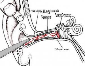 Перекись водорода в ухо: применение, лечение при боли и заложенности