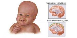 Менингит у детей: симптомы, менингеальные признаки, характер сыпи, как проявляется у новорожденных, лечение, последствия, меры профилактики