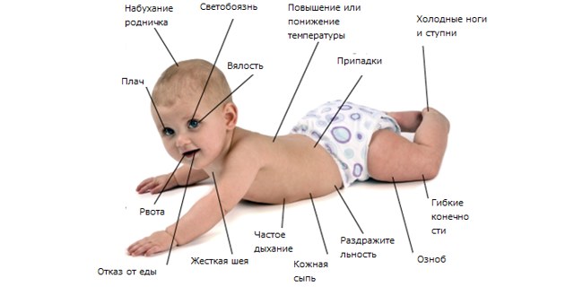 Менингит у детей: симптомы, менингеальные признаки, характер сыпи, как проявляется у новорожденных, лечение, последствия, меры профилактики