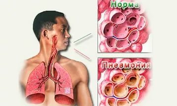 Стрептококк в горле: симптомы и лечение