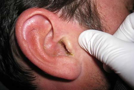 Отит среднего уха – симптомы и лечение у взрослых