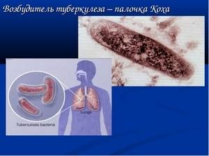 Диссеминированный туберкулёз лёгких заразен или нет?