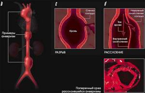Боль в грудной клетке слева: при вдохе, выдохе, дыхании и при движении