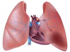 ТЭЛА (тромбоэмболия легочной артерии) – лечение болезни