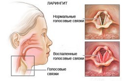 Стрептококк в горле: симптомы и лечение