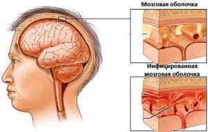 Симптомы менингита: вирусное и бактериальное воспаление у взрослых и детей, как распознать, сыпь, температура, менингеальные признаки, как болит голова
