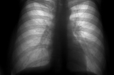 Флюорография и рентген легких: в чем разница, отличие, что лучше?