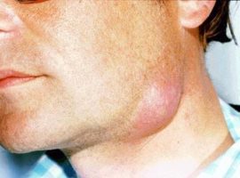 Лимфоузлы болят на шее: причины, симптомы, слева, справа
