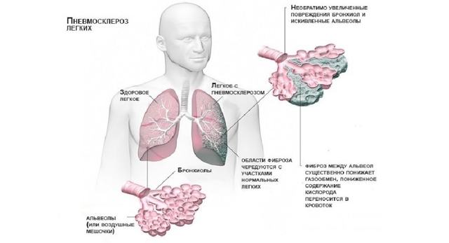 Диффузный пневмосклероз легких — что это такое и как лечить