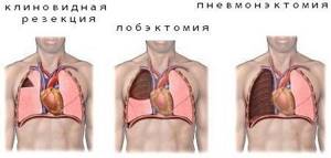 Инфильтративный туберкулез легких – симптомы и лечение