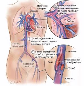 ТЭЛА (тромбоэмболия легочной артерии) – симптомы и неотложная первая помощь