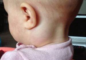 Лимфоузлы на шее у ребенка: с одной стороны, слева, справа, как лечить