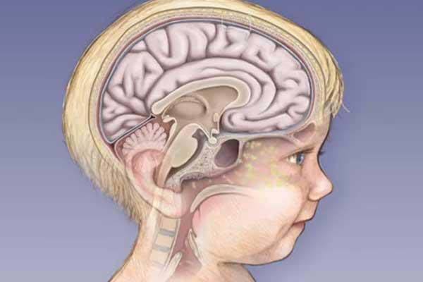 Симптомы менингита: вирусное и бактериальное воспаление у взрослых и детей, как распознать, сыпь, температура, менингеальные признаки, как болит голова