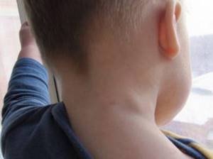 Увеличение лимфоузлов на шее: причины, с одной стороны, справа, слева, задние