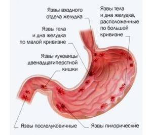 Боль в грудной клетке слева: при вдохе, выдохе, дыхании и при движении