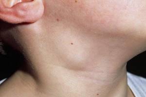 Воспаление лимфоузлов на шее: симптомы, причины, признаки, лечение