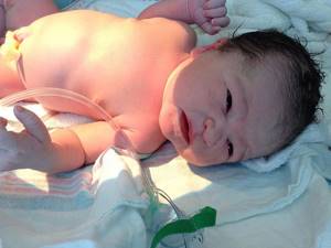 Асфиксия у новорожденных: последствия, профилактика и уход за ребенком