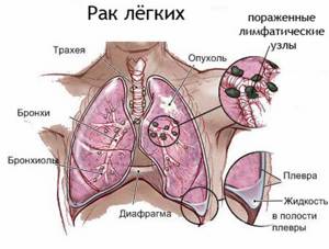 Рак легких – первые симптомы и признаки у мужчин и женщин на ранней стадии