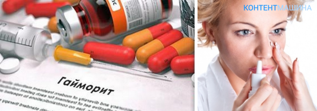 Препараты от гайморита: самые эффективные для взрослых людей, противовоспалительные, антибактериальные, Хлорофиллипт, Супрастин, Ибупрофен, Сиалор и другие