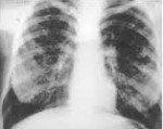 Диффузный пневмосклероз легких — что это такое и как лечить