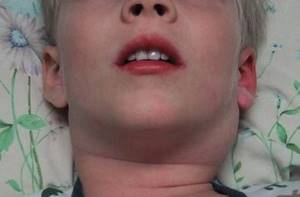 Лимфоузлы на шее у ребенка: с одной стороны, слева, справа, как лечить