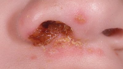 Золотистый стафилококк в носу: лечение и симптомы