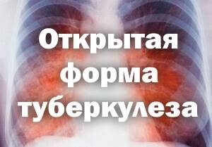 Как передается туберкулез открытой формы?
