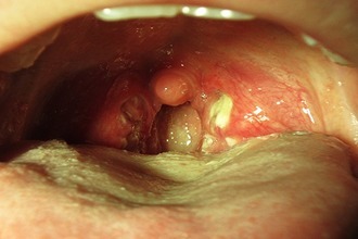 Золотистый стафилококк в горле: симптомы и лечение