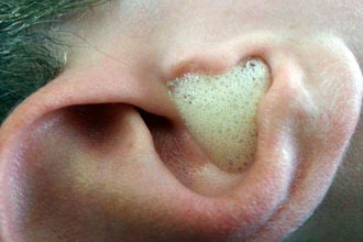 Перекись водорода в ухо при отите, лечение