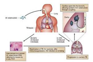 Первые признаки туберкулеза легких на ранних стадиях