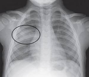 Рентген органов грудной клетки: что показывает, как часто можно делать, где сделать?