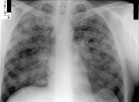 Диссеминированный туберкулёз лёгких заразен или нет?