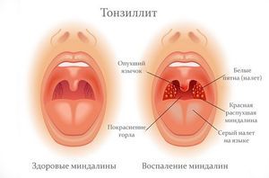 Чем полоскать горло при боли: дешевые и эффективные растворы