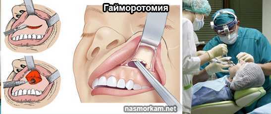 Одонтогенный гайморит: симптомы, лечение, антибиотики, народные средства, чем опасен, перфорация пазухи после удаления зуба