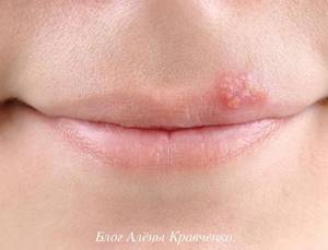 Простуда (герпес) на губах – лечение в домашних условиях