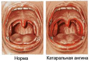Катаральная ангина: симптомы и лечение болезни